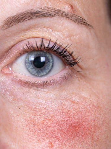 Photo of woman suffering from rosacea